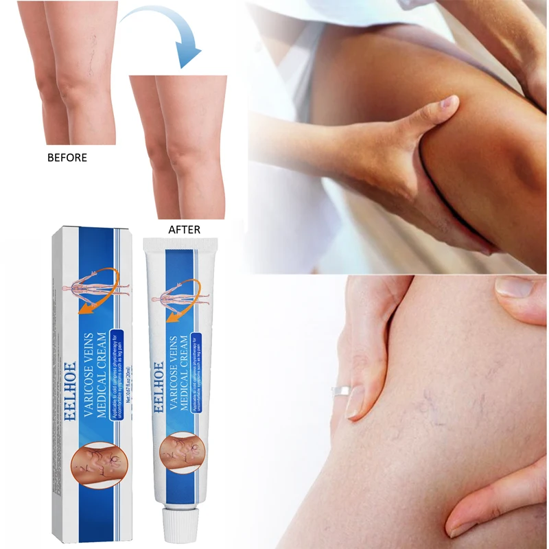 

Varicose Vein Massage Cream Treatment Vasculitis Phlebitis Soothing Leg Blood Vessel Bulge Pain Relief Ointment Body Care Cream