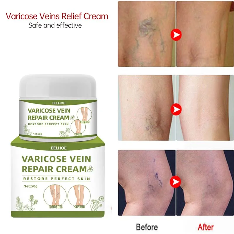 

Varicose Veins Treatment Cream Relieve Tired Legs Dilated Vasculitis Phlebitis Spider Pain Relief Ointment Health Safe Body Care