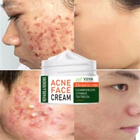 effective acne removal cream aloe fade acne marks spots shrink pores repair oil control whitening moisturizing skin care product