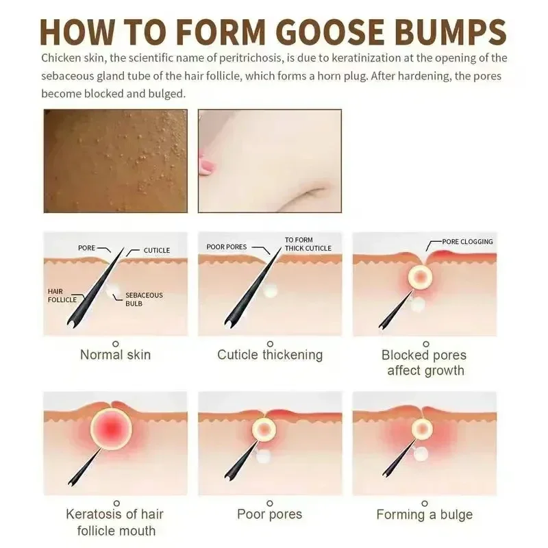 Крем для удаления куриной кожи крем тела уменьшает и удаляет омертвевшие клетки