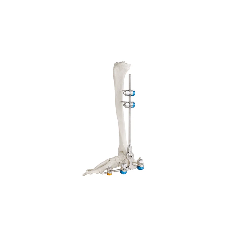 

Hot selling orthopedic ankle fusion joint fixator