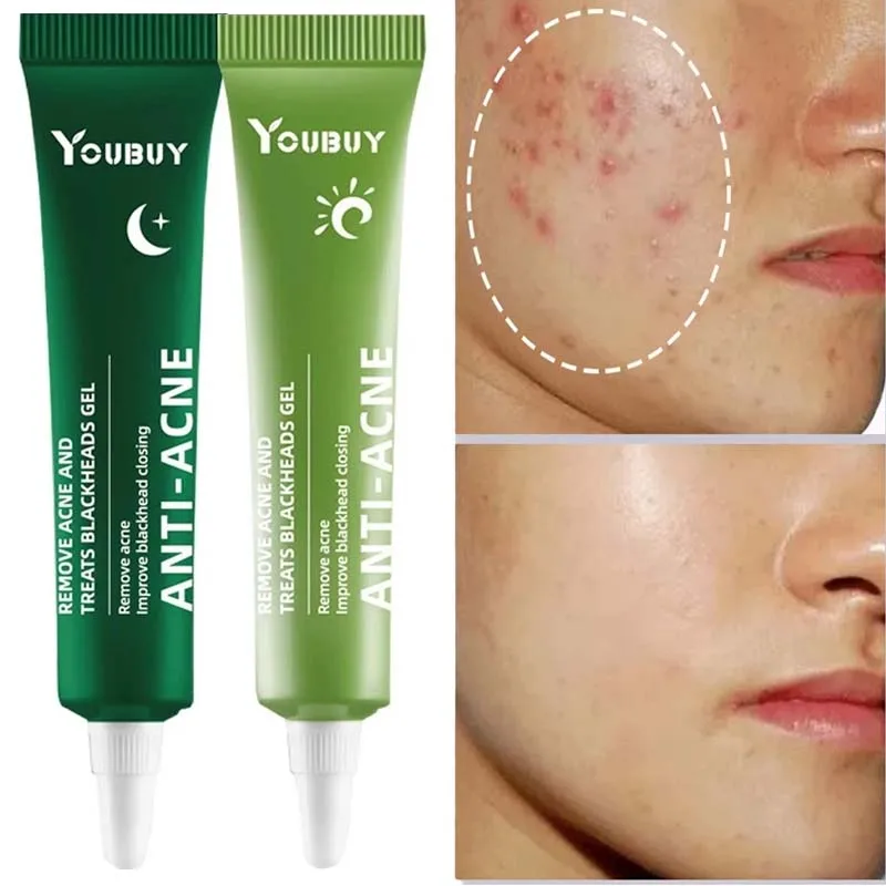 

Acne Removal Cream Whitening Effective Fade Acne Spots Repair Gel Oil Control Lighten Acne Marks Shrink Pores Acne Skin Care