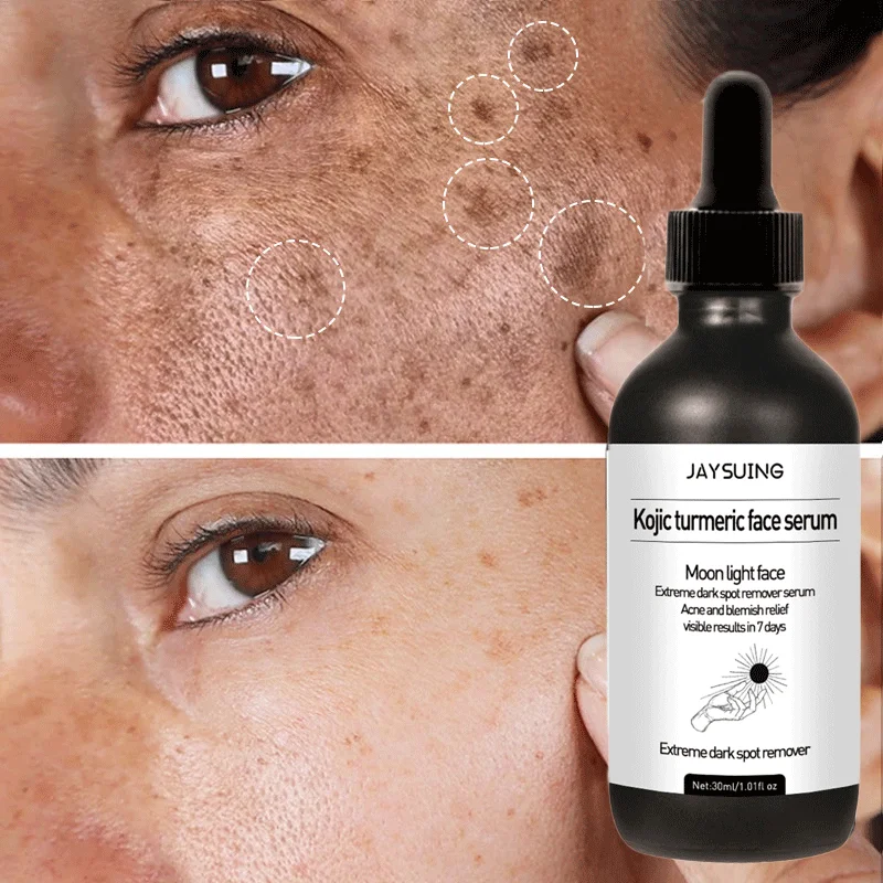 Whitening Freckle Serum Anti-Aging Remove Dark Spots Freckle Essence Fade Pigmentation Melasma Brighten Essence Face Skin Care
