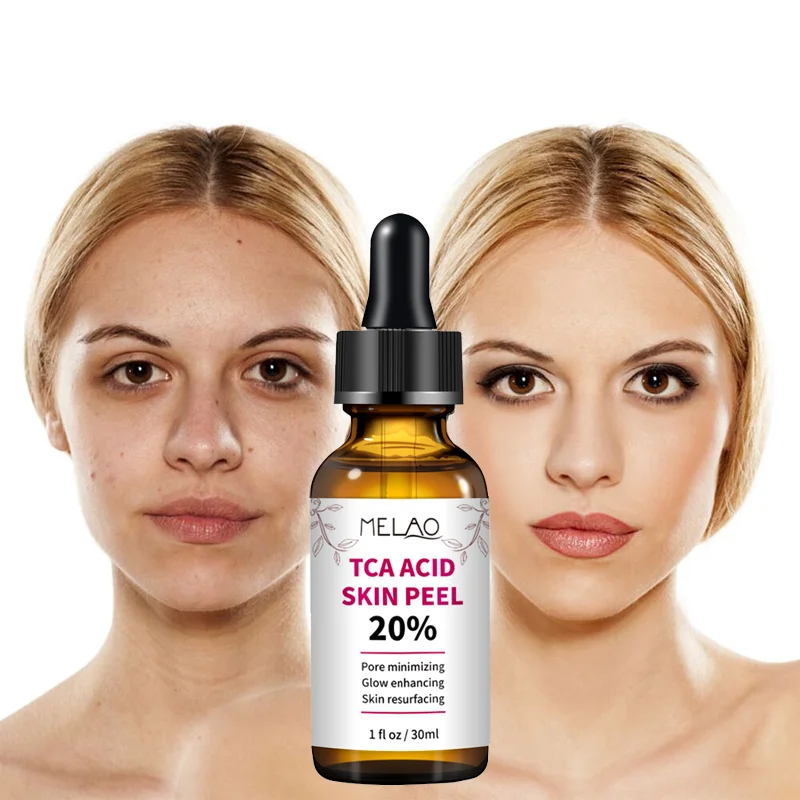 

20% TCA Acid Peel Chamomile Face Skin Whitening Anti Aging 30ML Trichloroacetic Acid Stock Solution Serum Improve Shrink Pores