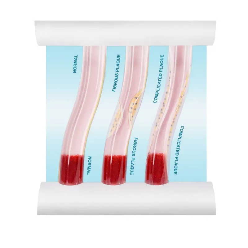 Трехсудочная модель сосудистый: здоровая артерия и симуляция блокировки в