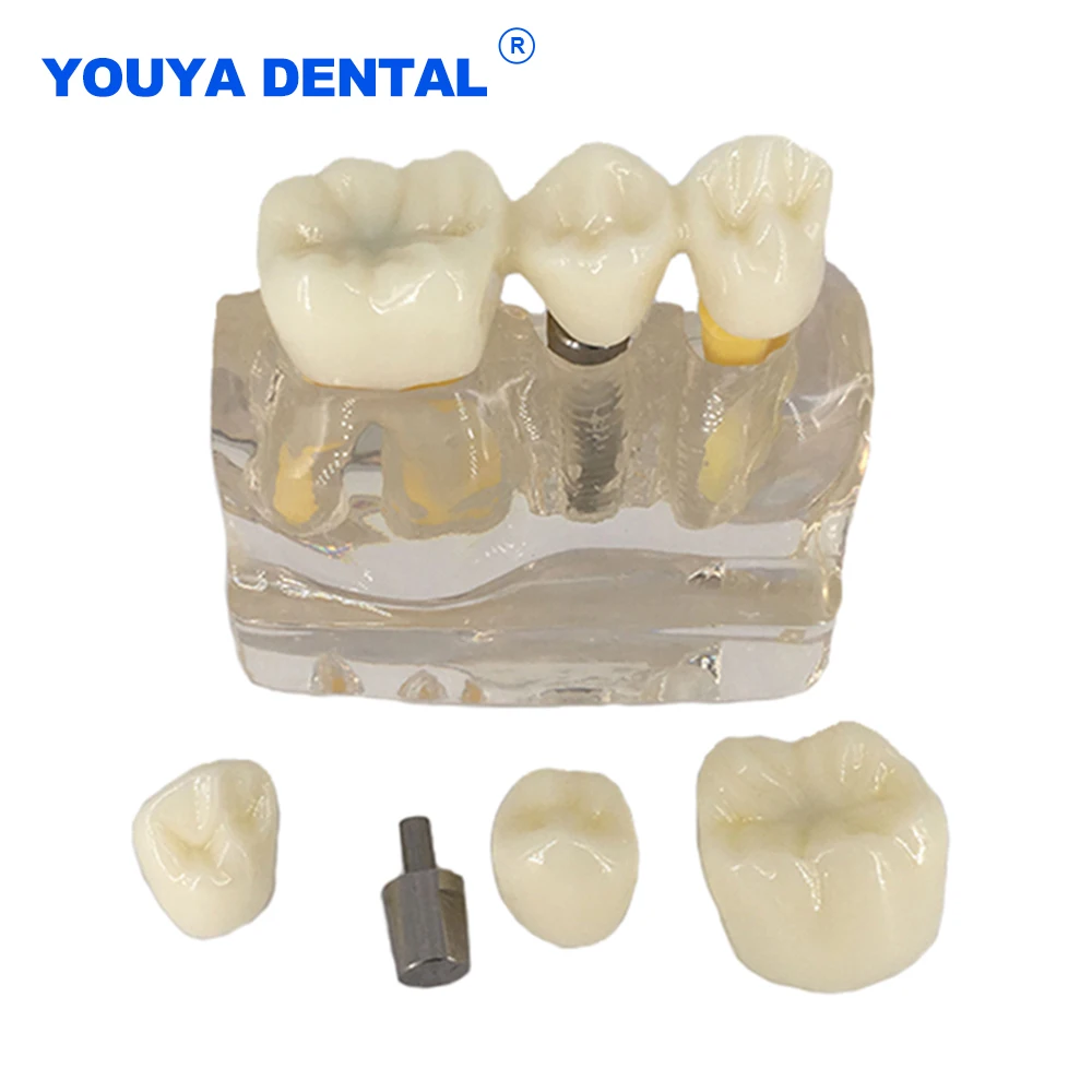 

Implant 4 Times Dental Model Teeth Analysis Crown Bridge Demonstration Removable Model Dental Teaching Dentistry clinic Research