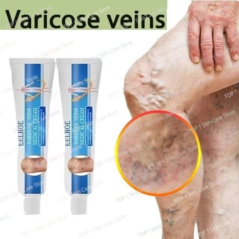 ГОРЯЧАЯ ПРОДАЖА мазь для лечения варикозного расширения вен снимает усталость