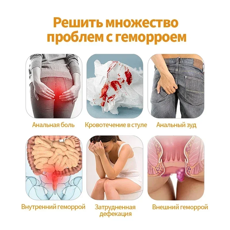 Геморрой 