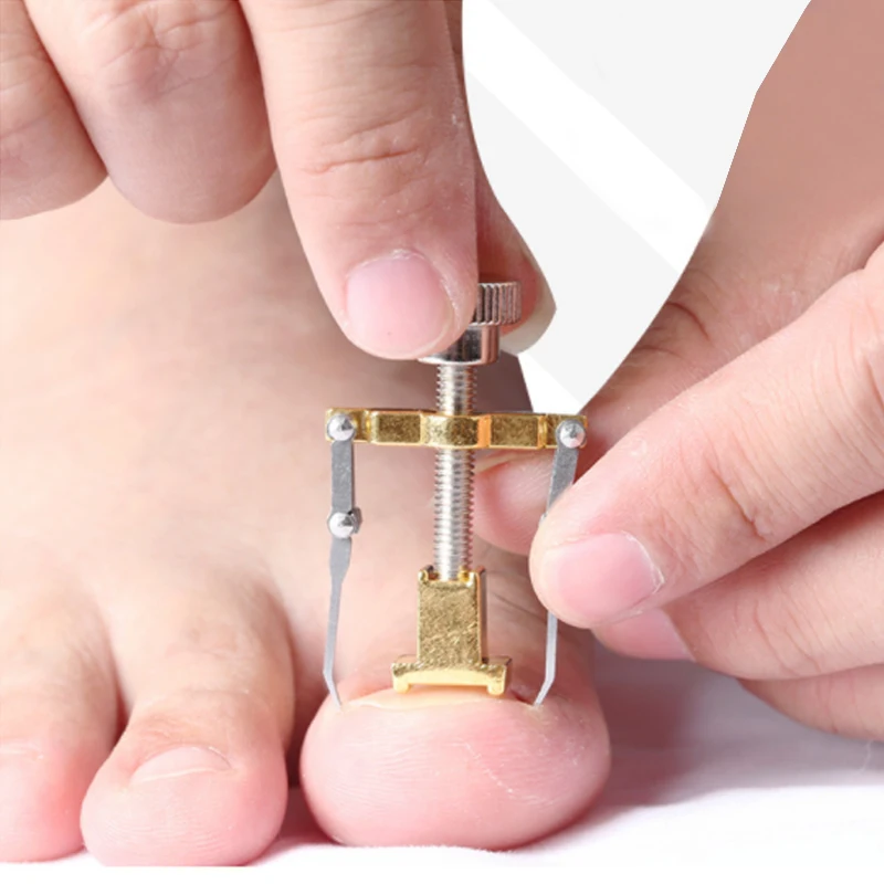 

Ingrown Toenail Toe Fixer Recover Correction Pedicure Foot Nail Care Tool Toe Special Ingrown Nail Corrector for Nail Groove