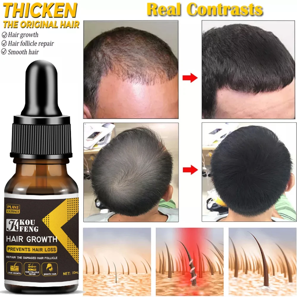 

Koufeng Ginger Essentials Hair Growth Products For Men Women Fast Regrowth Oil Hair Scalp Treatment Hair Grow Beauty Health