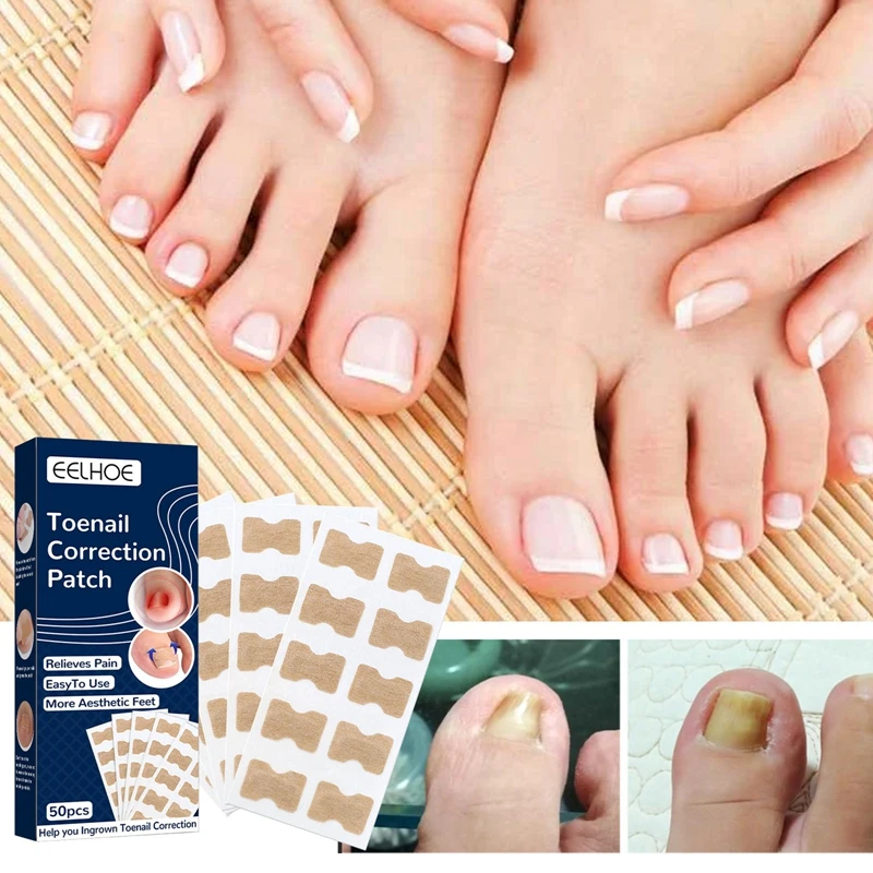 

50pcs Ingrown-Toenail Sticker Non-Glue Toenail Correction Patch Toe Correction Sticker Toe Inlay Nail Corrector Pedicure Tool