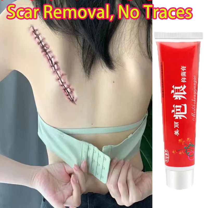 

Lavender Acne Scar Stretch Marks Removal Cream Pimples Stretch Marks Face Gel Acne Smoothing Whitening Moisturizing Body