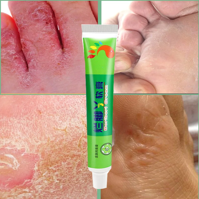 

Remove Odor Athlete's Foot Keratinized Athlete Cream Deodorant Peeling Relieve Itching Smear Ointment Herbal Antibacterial