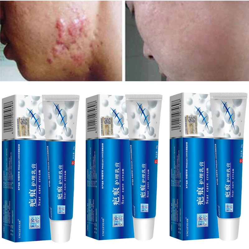 

Pigmentation Corrector Acne Scar Removal Cream Pimples Stretch Marks Remove Acne Smoothing Whitening Moisturizing Body Skin Care