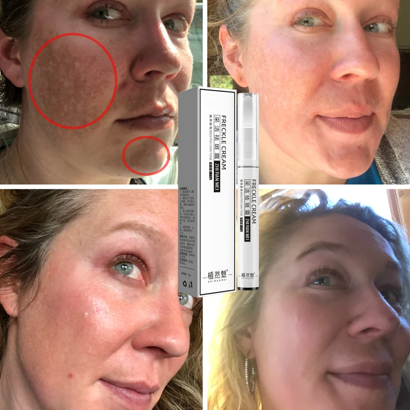 15g Whitening Freckles Cream Remove Melasma Dark Spot Lightening Melanin Moisturize Brighten Face Skin Care