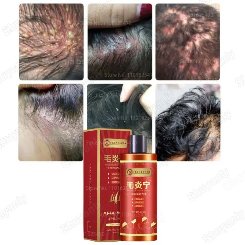 

Hair Psoriasis Seborrheic Treatment Dermatitis Eczema Compound Herbal Shampoo Anti Dandruff Dermatitis Relieve Flaking Itching