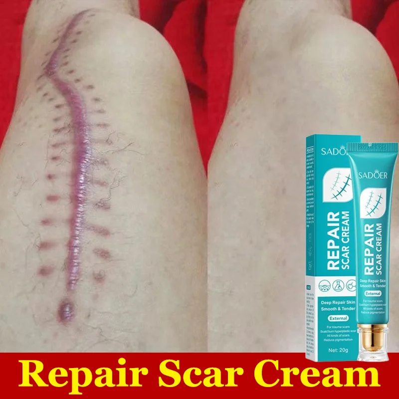 Крем для удаления шрамов и растяжек крем перманентного лечение хирургических