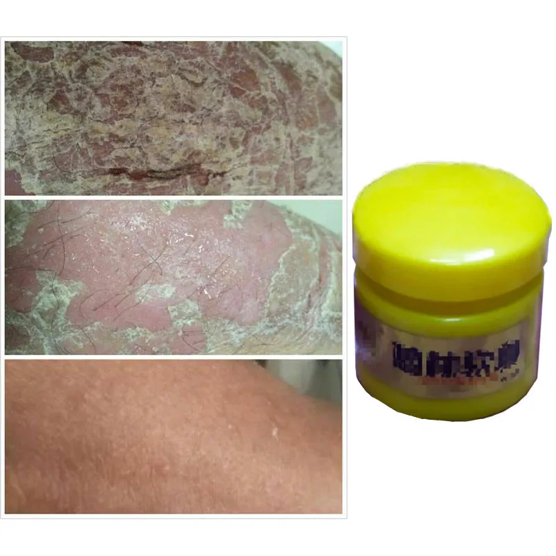 

Dithran ol Ointment 20g psoriasis, scalp Tinea, skin pruritus, dermatitis and eczema
