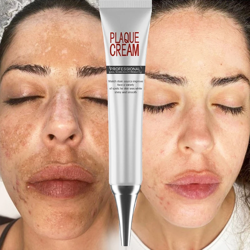 

Whitening Freckle Remove Cream Plaque Dark Spots Melanin Melasma Correcting Fade Acne Scars Brighten Anti-Aging Moisturizing Gel