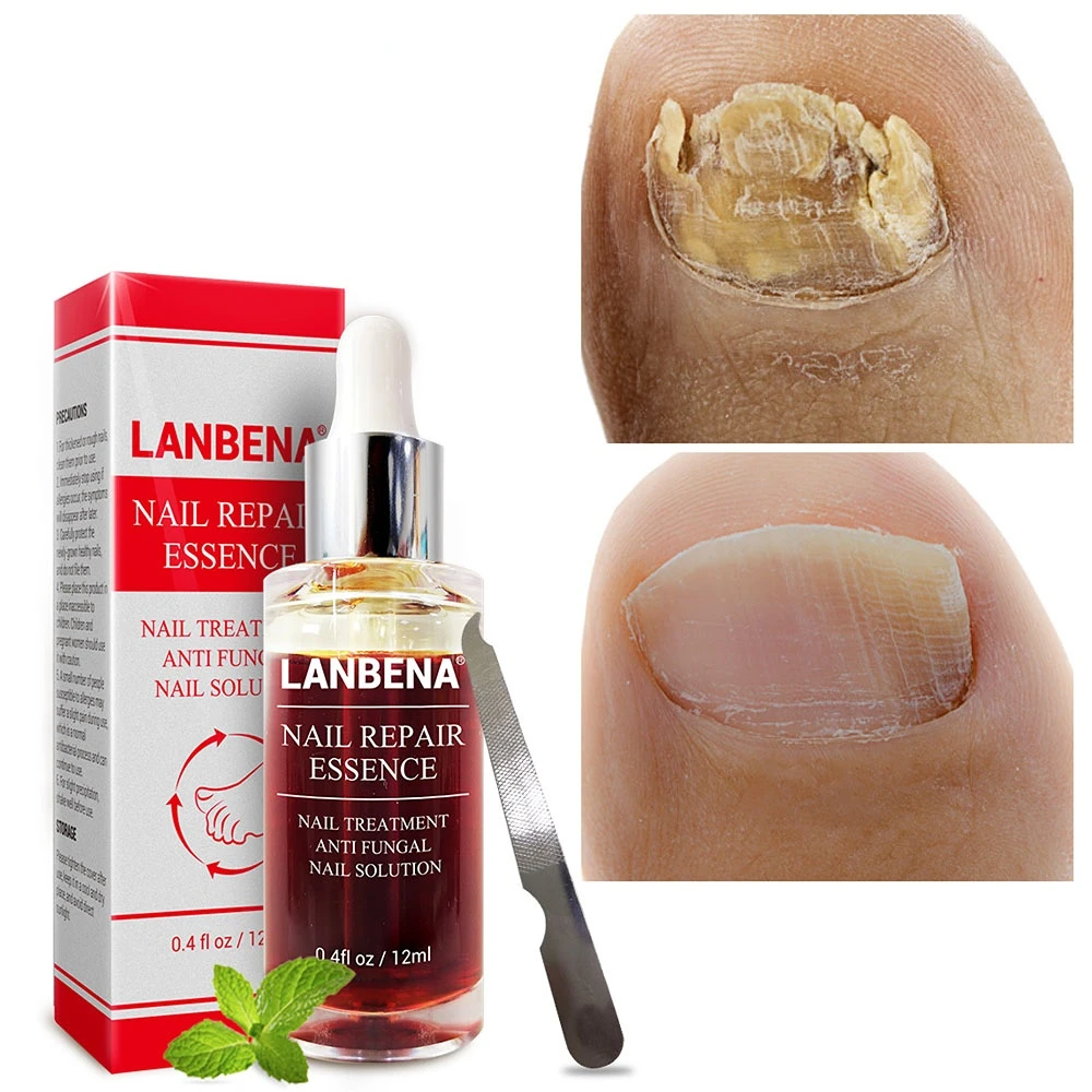 Средство от грибка ногтей. Fungal treatment solution для ногтей. Средство от грибка ногтей на ногах. Китайское средство от грибка fungal nail treatment. Лечение ногтей на ногах препараты отзывы.