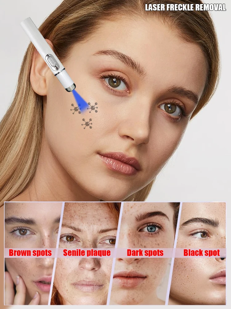 Отбеливание кожи лица темных пятен мелазмы веснушек