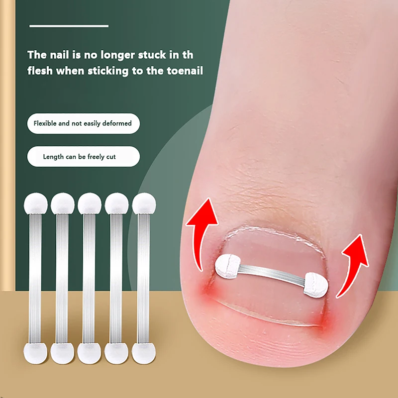 

Foot Care Tool Ingrown Toenail Corrector Tools Pedicure Recover Embed Toe Nail Treatment Professional Ingrown Toenail Correction