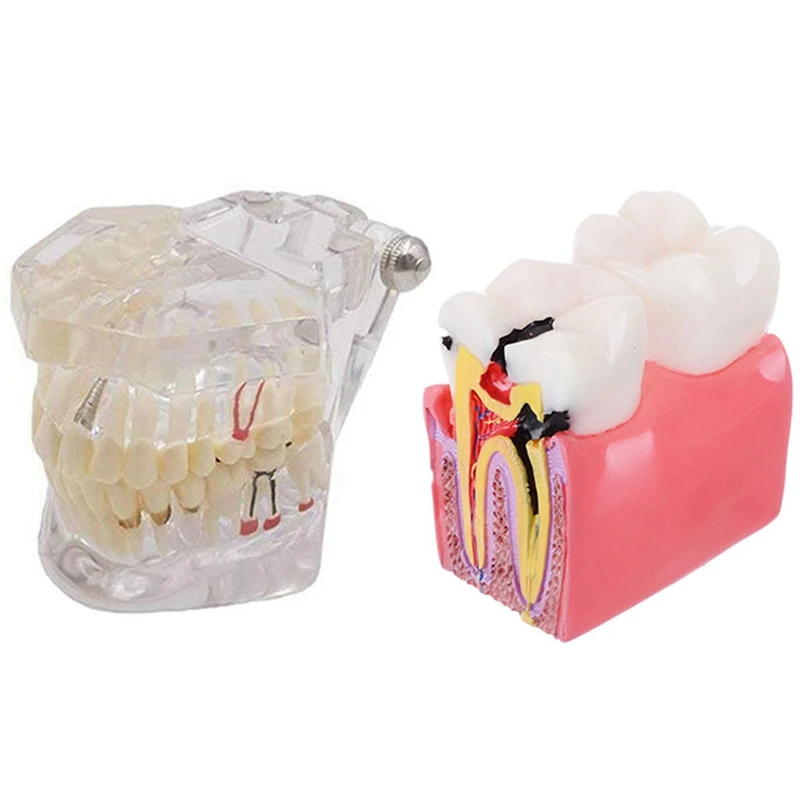 

1Pcs Oral Hygiene Implant Disease Teeth Model & 1Pcs Anatomy 6 Times Caries Comparative Study Models