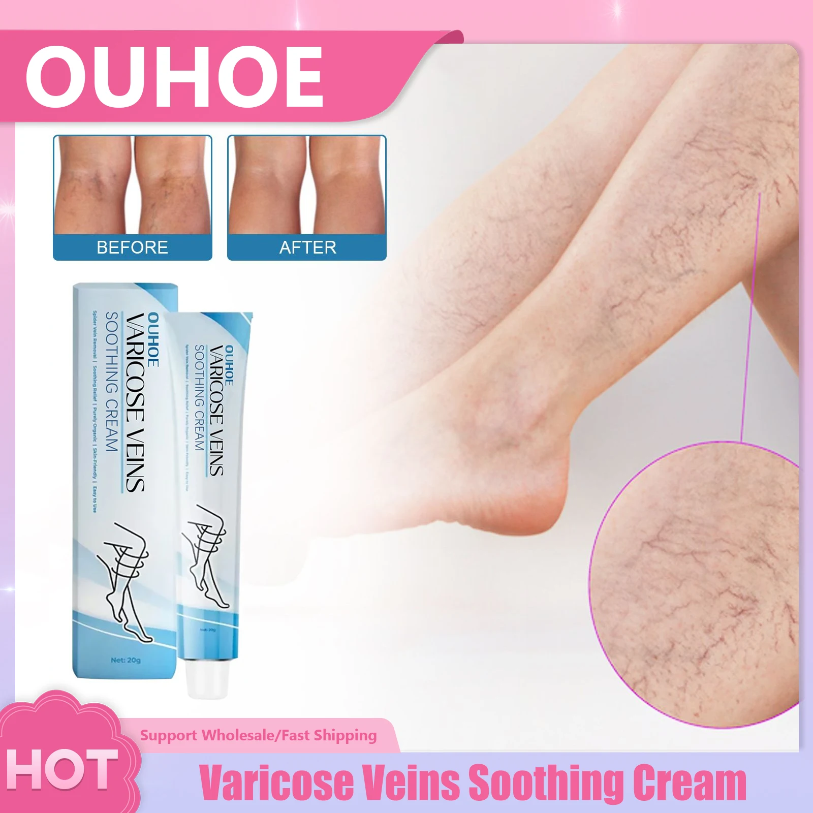 

Varicose Veins Soothing Cream Eliminate Vasculitis Phlebitis Relief Pain Improve Blood Circulation Spider Leg Treatment Ointment