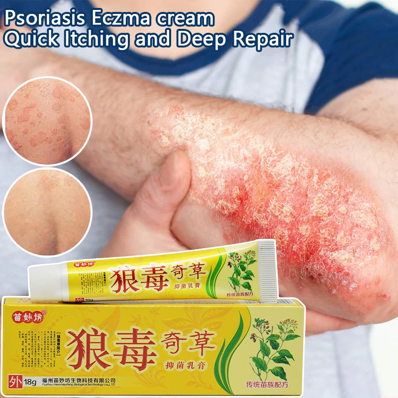 Useful Psoriasis Cream Psoriasis Ointment Dermatitis Eczematoid Eczema Ointment Skin Treatment Cream