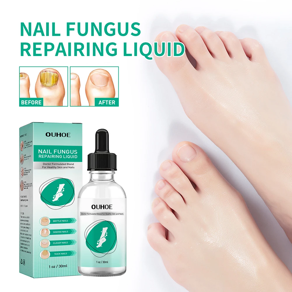 

30ml Toenail Fungus Oil Nail Repair Liquid for Fingernails Anti Fungal Solution Whitening Toe Feet Care