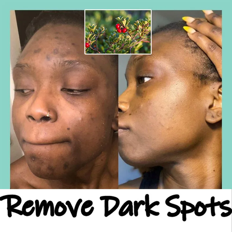 

Melanin Removal Dark Spots Arbutin Corrector Serum Reduce Pigmentation Facial Moisturizing Lighten Acne Marks Brighten Skin Tone
