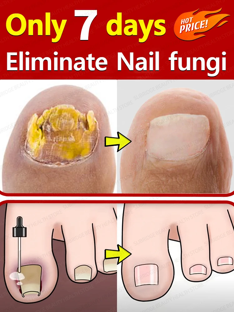 Растворите проблемы с ногтями