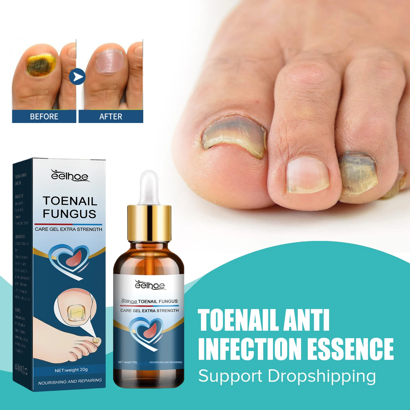 

Anti Paronychia Serum Onychomycosis Anti Infection Reduce Ingrown Disinfects Restore Shine Toenail Fungus Removal Essential Oil