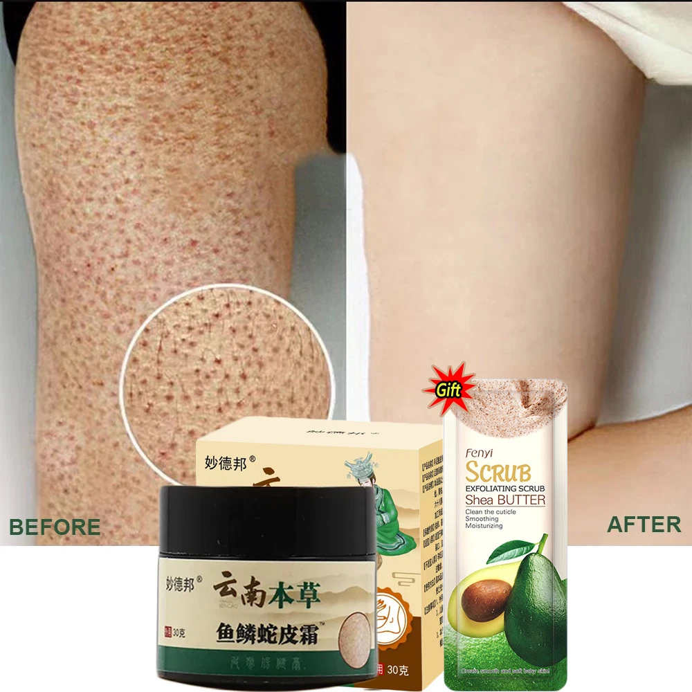 

Curing Keratosis Pilaris Repair Cream Chicken Follicle Skin Body Scrub Brighten Dark Spots Remove Smooth Moisturize Skin Care