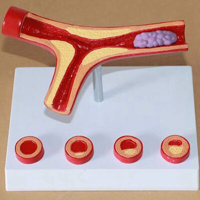 Прибор для обучения атеросклерозу человека модель сосудистой анатомии ветка