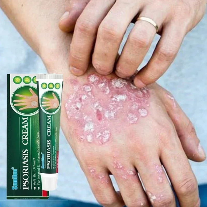 ГОРЯЧАЯ ПРОДАЖА 20 г травяной крем от псориаза антибактериальный средство против