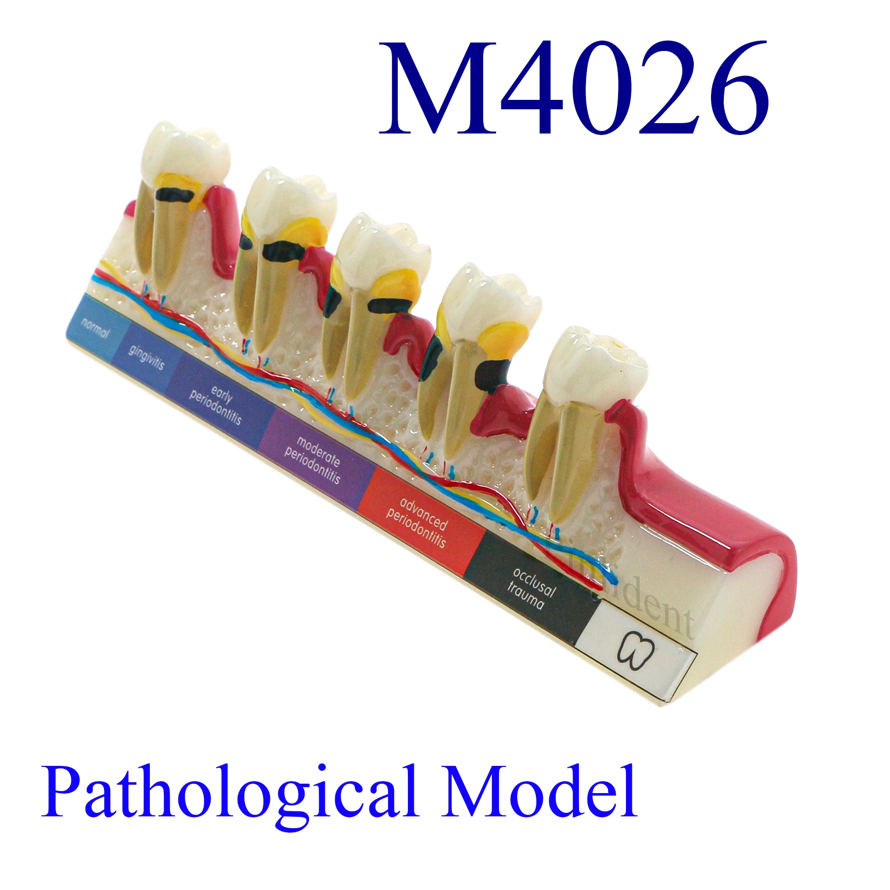 Модели заболеваний пародонта Кариес Классификация процесса Связь