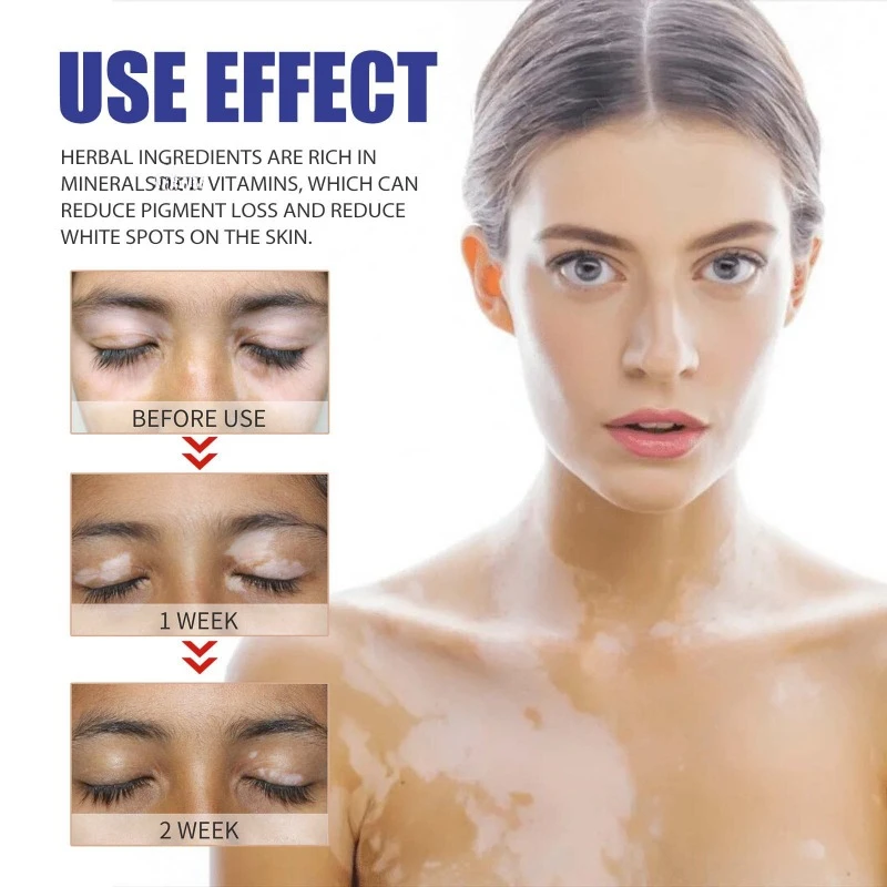 Сыворотка для лечения Vitiligo лампа роста пигмента Ringworm Tinea удаление пота и белых