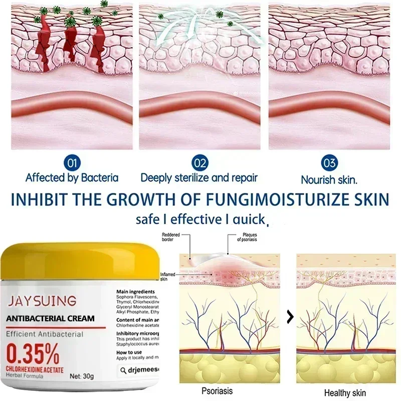 HOT SALE Treatment of stubborn psoriasis moss special drug ointment body and thigh dermatosis itching antibacteri