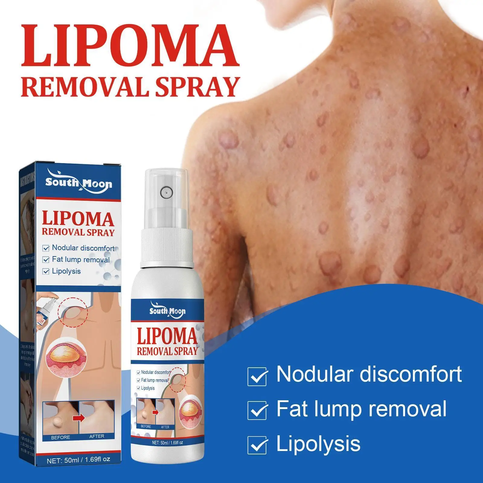 

Крем Lipoma Q2X2 для удаления бородавок, лечение бородавок, акне, трав