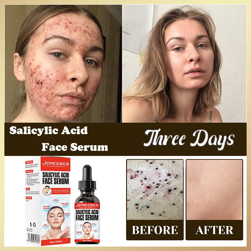 

Salicylic Acid Solution Essence 30mL Acne Spot Removing Shrink Pores Oil-Control Brighten Face Skin Makeup