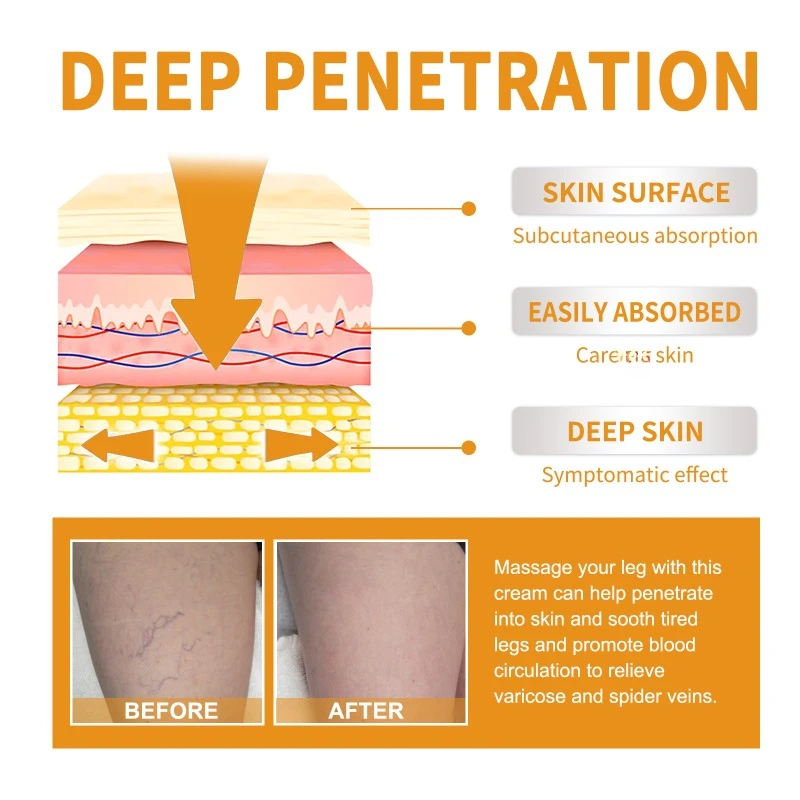 Крем с витамином K для лечения варикозного расширения вен флебит варикозное