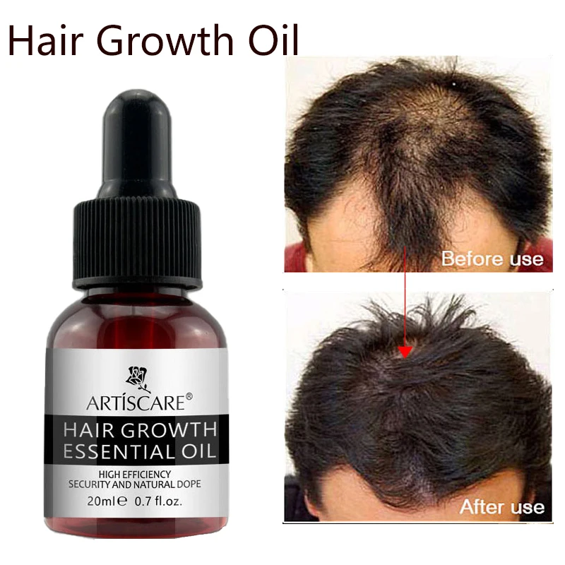 

Ginger Hair Growth Products Anti Hair Loss Essence Oil Fast Growing Serum Treatement Scalp Prevent Follicle Damaged Hair Care