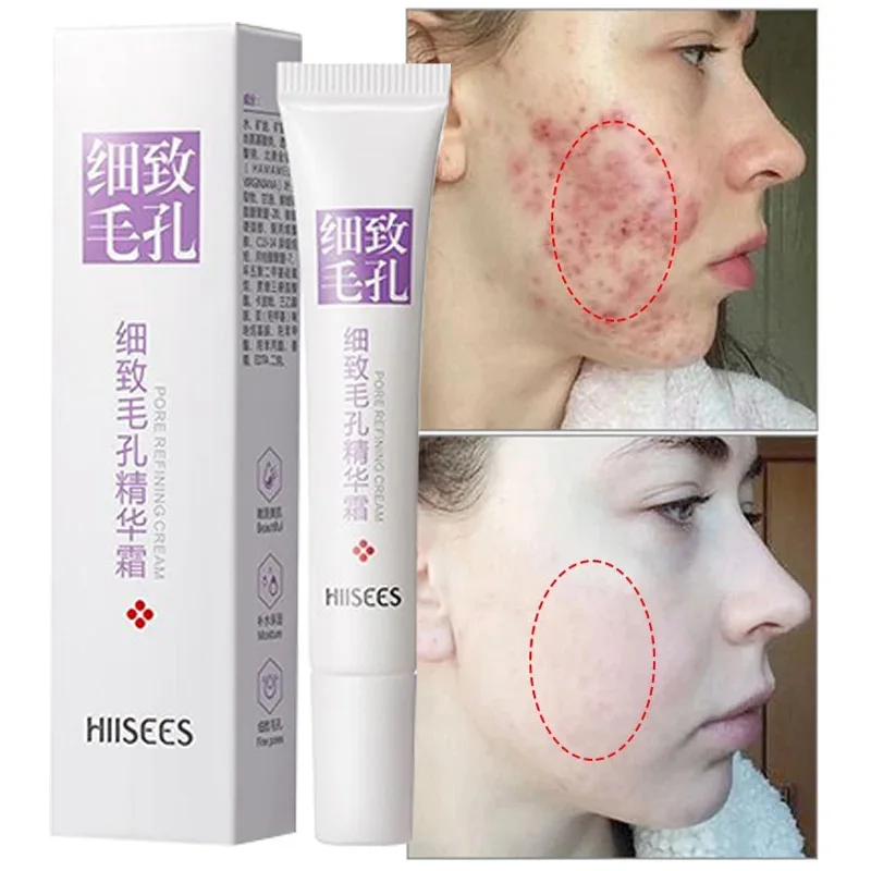 Крем от акне | AliExpress