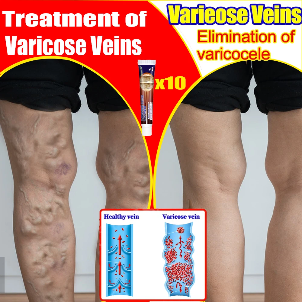 

Varicose Vein Cream Remove Veins Treatment for Legs Eliminated Vasculitis Phlebitis Spider Pain Relieve Foot Blood Circulation