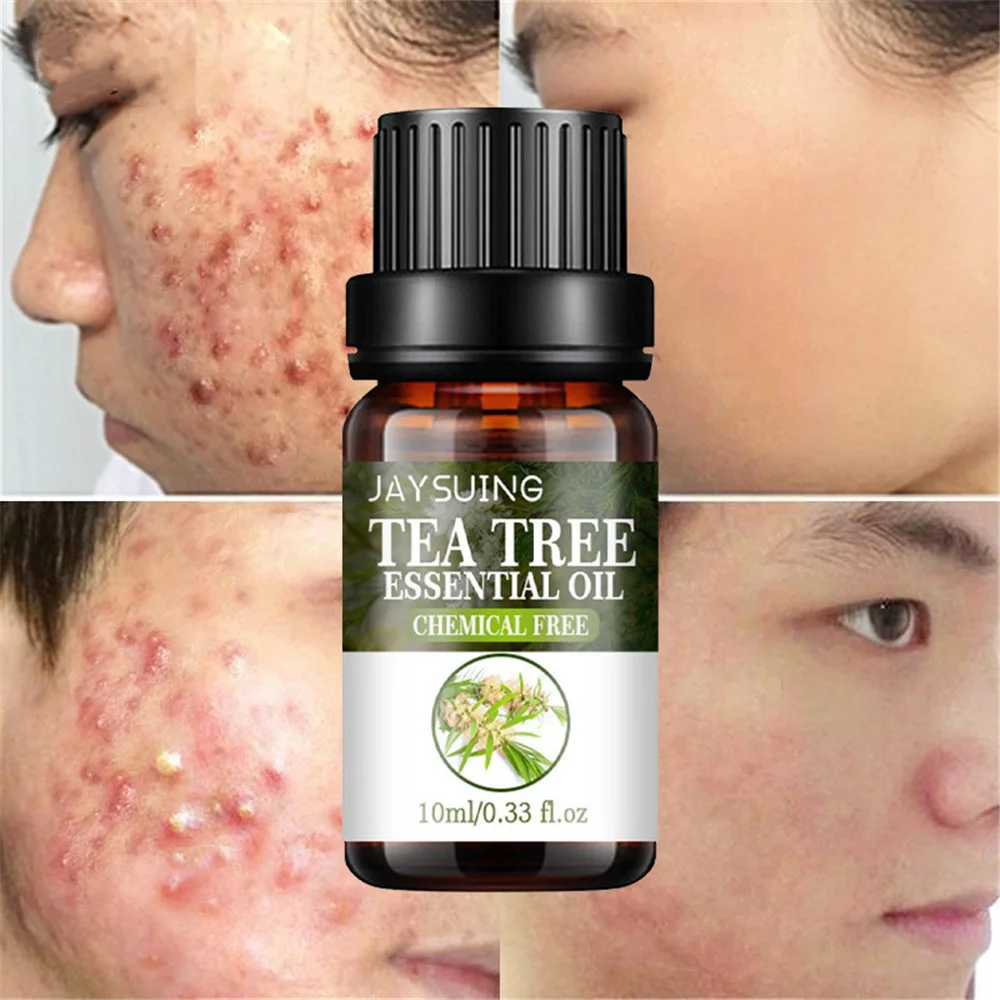 

Tea Tree Acne Remove Essential Oil Anti-Acne Serum Fade Acne Spots Scars Marks Essence Shrink Pores Oil Control Whitening Skin