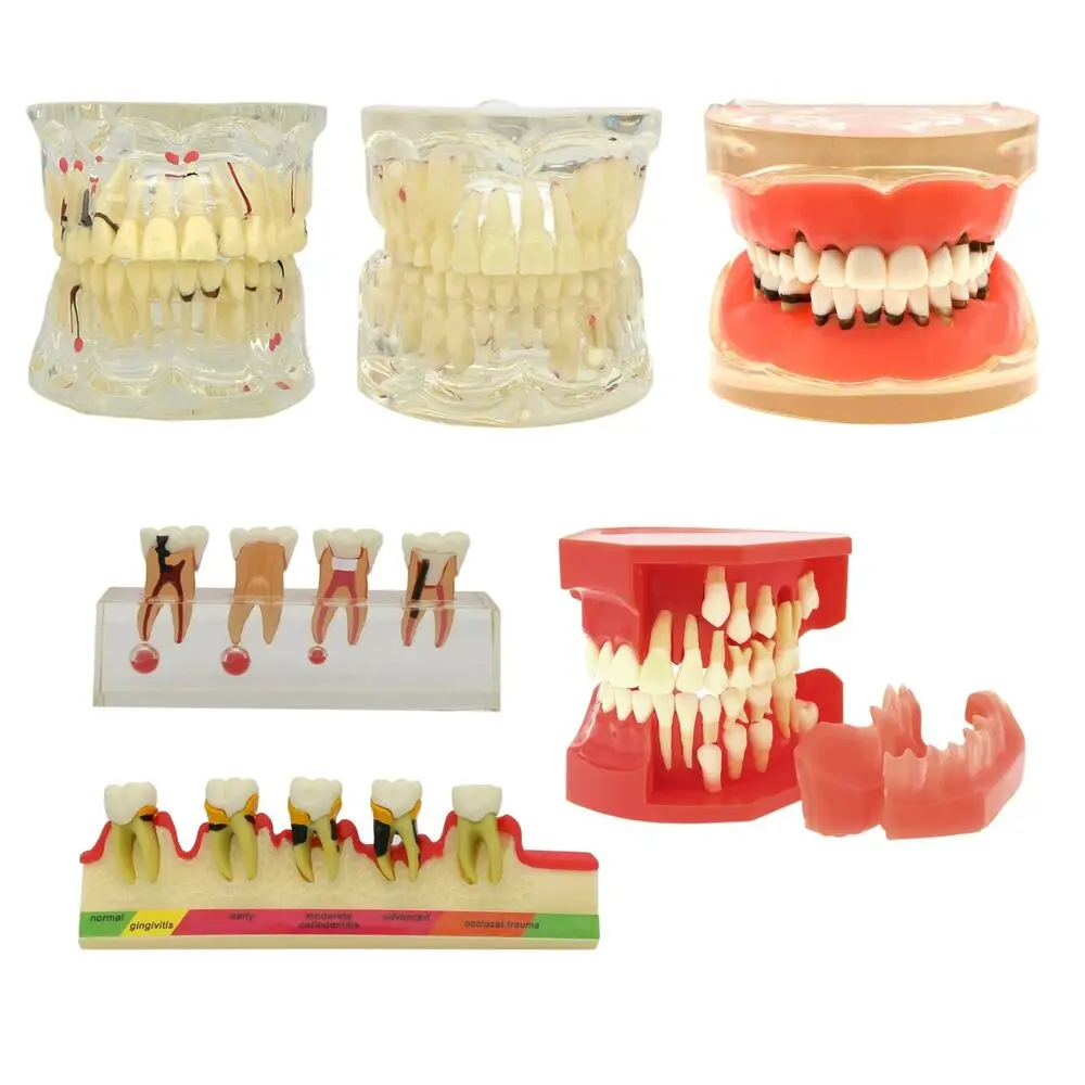 Dental Pathological Typodont Teeth Model Periodontics/Implant/Endodontic Caries dental odontología