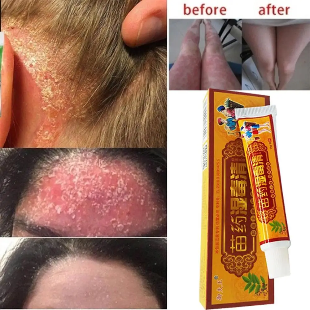 

1pc Natural Chinese Medicine Analgesic Cream Wet Poison Herbal Qing Cream Arthritis Joint Pain Relief Cream Analgesic Pain P1A3