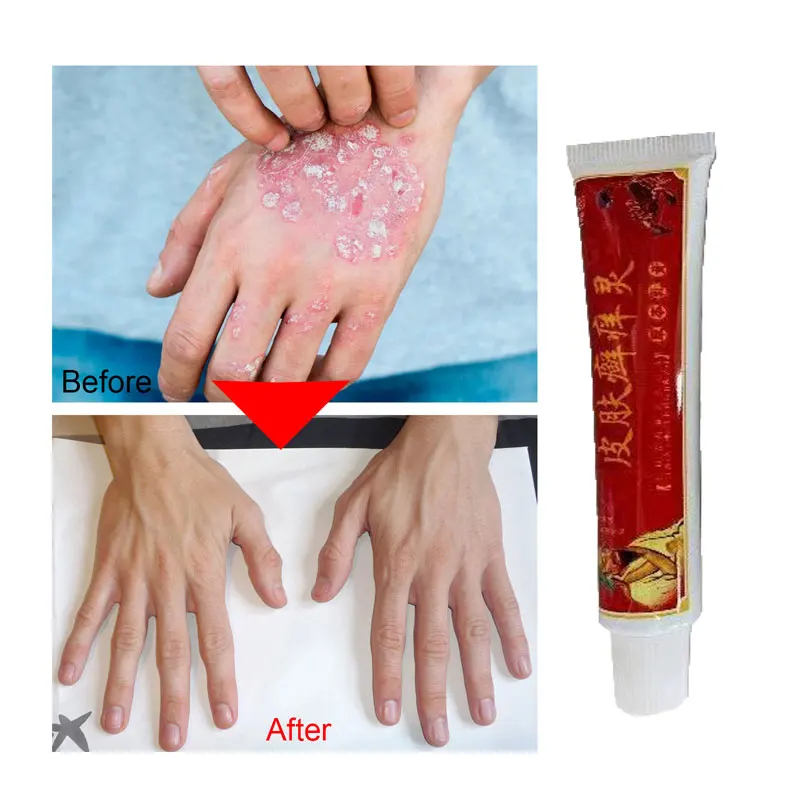 

Herbal Extract Effective Treatment Fungus Foot Cream Anti Fungal Infection Atopic DermatiTis Skin Repair Cream