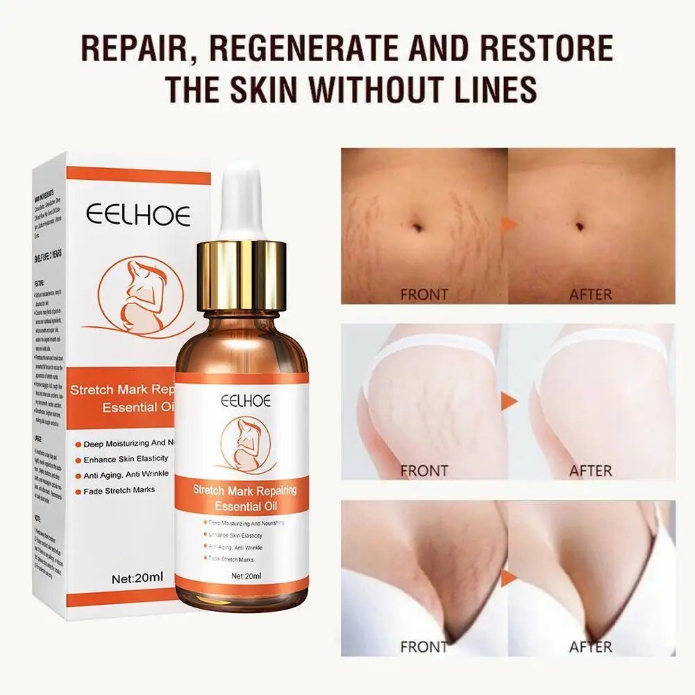 

Stretch Marks Removal Essential Oil 20ml Maternity Repair New Old Stretch Mark Removal Cream Anti-Winkles Firming Body Skin Care
